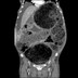 Fecalome géant  TDM Abdomen Axial Temps veineux