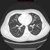 Hereditary hemorrhagic telangiectasia with lung arteriovenous malformation  CT Thorax Axial Arterial phase