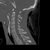 Clinical case 6 - Polytrauma severe cranial injury following road traffic accident