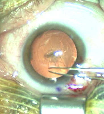 Cataracte sous capsulaire postérieure et astigmatisme cornéen - Implantation multifocale torique Rhexis