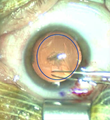 Cataracte sous capsulaire postérieure et astigmatisme cornéen - Implantation multifocale torique Rhexis