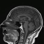 Schwannome cochléovestibulaire (neurinome de l'acoustique) T1 SE SAG Schwannome cochléovestibulaire (neurinome de l'acoustique) T1 SE SAG