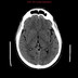 Déficit hémicorporel droit et corps étranger intra crânien  Radiographie Crâne Profil