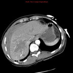 Embolisation hépatique d'un hématome post-traumatique TDM Thorax Abdomen Axial Temps artériel Embolisation hépatique d'un hématome post-traumatique TDM Thorax Abdomen Axial Temps artériel