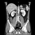 Adénocarcinome du colon transverse.  TDM Abdomen Axial Temps veineux
