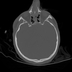 Clinical case 6 - Polytrauma severe cranial injury following road traffic accident