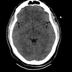 Clinical case 11 - Polytrauma due to a very high-speed single light vehicle road traffic accident