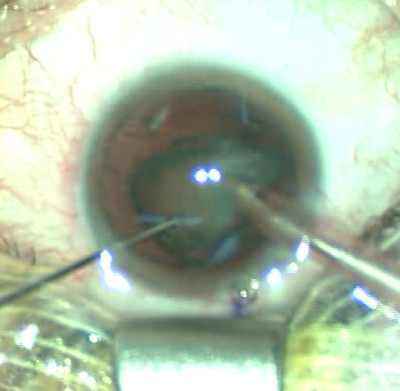 Cataracte sous capsulaire postérieure et astigmatisme cornéen - Implantation multifocale torique Phacoaspiration