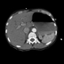 Clinical case 14 - Polytrauma due to high-speed road traffic accident, light vehicle against light vehicle, patient driving and wearing belt