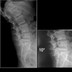 tumeur rachis  Image1