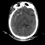 traumatisme cranien grave, dissection carotidienne, pneumopathie d'inhalation, fracture pelvienne crane axial mou traumatisme cranien grave, dissection carotidienne, pneumopathie d'inhalation, fracture pelvienne crane axial mou
