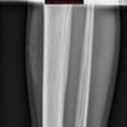 Plaies des parties molles de la cheville par arme à feu Radiographie Membre inférieur Face Plaies des parties molles de la cheville par arme à feu Radiographie Membre inférieur Face