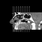 ATCD DCA et DCR Gauche - Bilan de larmoiement à droite ORBITE IV CORO ATCD DCA et DCR Gauche - Bilan de larmoiement à droite ORBITE IV CORO