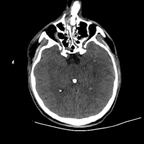 traumatisme cranien, oedème pulmonaire, lacération du rein crane axial mou traumatisme cranien, oedème pulmonaire, lacération du rein crane axial mou