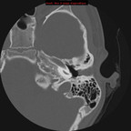 Aplasie mineure de l'oreille gauche TDM rocher gauche : axial Aplasie mineure de l'oreille gauche TDM rocher gauche : axial