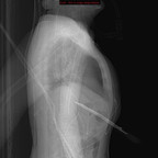 Traumatisme pénétrant abdominal par couteau Radiographie Abdomen Profil Traumatisme pénétrant abdominal par couteau Radiographie Abdomen Profil