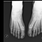 Осложнения болезни Фрейберга Avant pieds Face Осложнения болезни Фрейберга Avant pieds Face