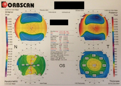 Cataracte sous capsulaire postérieure et astigmatisme cornéen - Implantation multifocale torique Topographie cornéenne OG