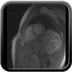 Myocardite virale T2 dark blood avec saturation de la graisse
