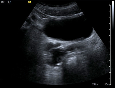 Kyste de la vésicule séminale et agénésie rénale homolatérale Echographie Pelvis Axial