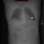 Plaie par balle avec fracture du pelvis, plaie de l'urètre et hématome du muscle fessier Scoot Plaie par balle avec fracture du pelvis, plaie de l'urètre et hématome du muscle fessier Scoot