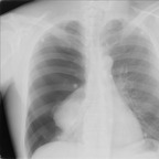 Pneumothorax complet droit AP Chest X-ray Pneumothorax complet droit AP Chest X-ray