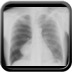 Right chest pain and dyspnea AP Chest X-ray