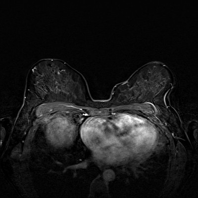 Right upper medial ductal carcinoma in situ Soustraction 2 min