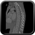 Clinical case 14 - Polytrauma due to high-speed road traffic accident, light vehicle against light vehicle, patient driving and wearing belt