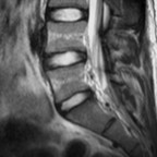 malformation vasculaire épidurale de la région lombosacrée IRM de la région lombosacrée malformation vasculaire épidurale de la région lombosacrée IRM de la région lombosacrée