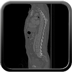 Clinical case 2 - AVP polytrauma high velocity Head CT in soft tissue window
