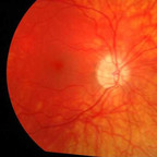 Drüsens papillaires Fond d oeil oeil droit Drüsens papillaires Fond d oeil oeil droit