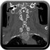 Clinical case 2 - AVP polytrauma high velocity