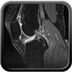Knee encondroma  MRI Lower limb Axial
