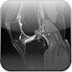 Tibial encondroma  MRI Lower limb Axial