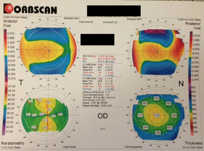 Cataracte sous capsulaire postérieure et astigmatisme cornéen - Implantation multifocale torique Topographie cornéenne OD