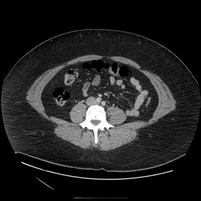 Phéochromocytome bilatéral, tumeurs rénales et kystes rénaux dans le cadre d'une maladie de Von Hippel Lindau TDM portal
