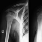 хондробластома Radiographie Membre supérieur хондробластома Radiographie Membre supérieur