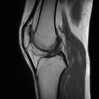 Медиальная синовиальная складка IRM genou Sagittal T1 TSE Медиальная синовиальная складка IRM genou Sagittal T1 TSE