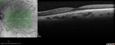 Cataracte sous capsulaire postérieure et astigmatisme cornéen - Implantation multifocale torique OCT maculaire OG