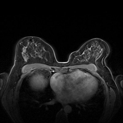 Right upper medial ductal carcinoma in situ Dynamique FS 3 min