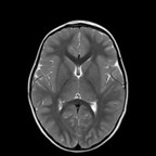 neurofibromatose de type 1 IRM axial crâne T2 neurofibromatose de type 1 IRM axial crâne T2