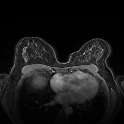 Right upper medial ductal carcinoma in situ Dynamique FS 1 min