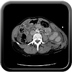 Clinical case 14 - Polytrauma due to high-speed road traffic accident, light vehicle against light vehicle, patient driving and wearing belt