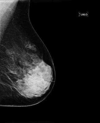 Doubt regarding architectural distortion of the right upper lateral quadrant, corresponding to superimpositions with tomosynthesis. LMLO