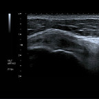 Tendinopathie supra épineux et conflit antero superieur Echographie Membre supérieur Tendinopathie supra épineux et conflit antero superieur Echographie Membre supérieur