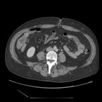 diverticulite sigmoidienne non compliquée TDM Axial temps portal diverticulite sigmoidienne non compliquée TDM Axial temps portal