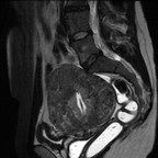 Léiomyomatose utérine diffuse Sagittal T2 Léiomyomatose utérine diffuse Sagittal T2
