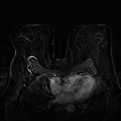Doubt regarding architectural distortion of the right upper lateral quadrant, corresponding to superimpositions with tomosynthesis. Soustraction 3 min