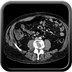 Epaississement jéjunal isolé en rapport avec une maladie de Crohn.  TDM Abdomen Coronal Temps veineux